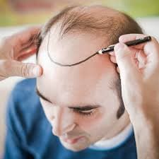 Haartransplantation Türkei Kosten Unveiled: Affordable Options Await